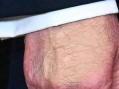 Após preocupações com uma mão machucada, Trump defendeu sua saúde