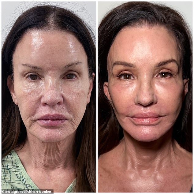 108811517-15839477-Janice_Dickinson_received_a_full_facial_overhaul_with_plastic_su-a-21_1779482855879.jpg
