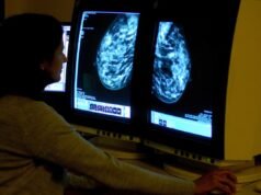 Milhões de pacientes com câncer de mama poderiam evitar a quimioterapia com um novo teste genômico